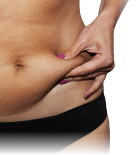 גוף אישה לפני טיפול המסת שומן בגלי רדיו