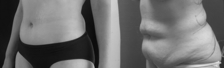 גוף אישה לפני ואחרי שאיבת שומן